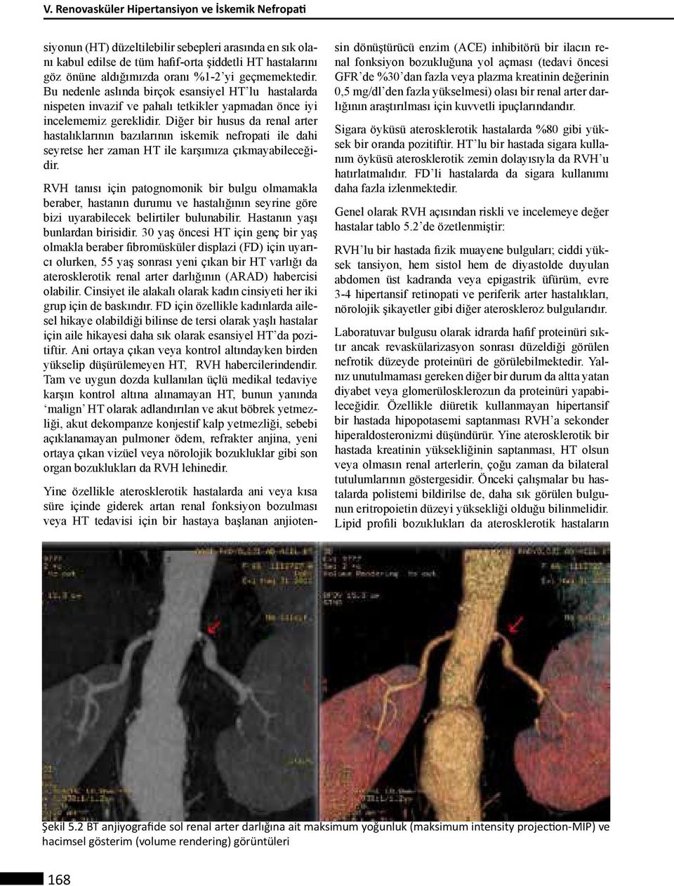 Diğer bir husus da renal arter hastalıklarının bazılarının iskemik nefropati ile dahi seyretse her zaman HT ile karşımıza çıkmayabileceğidir.