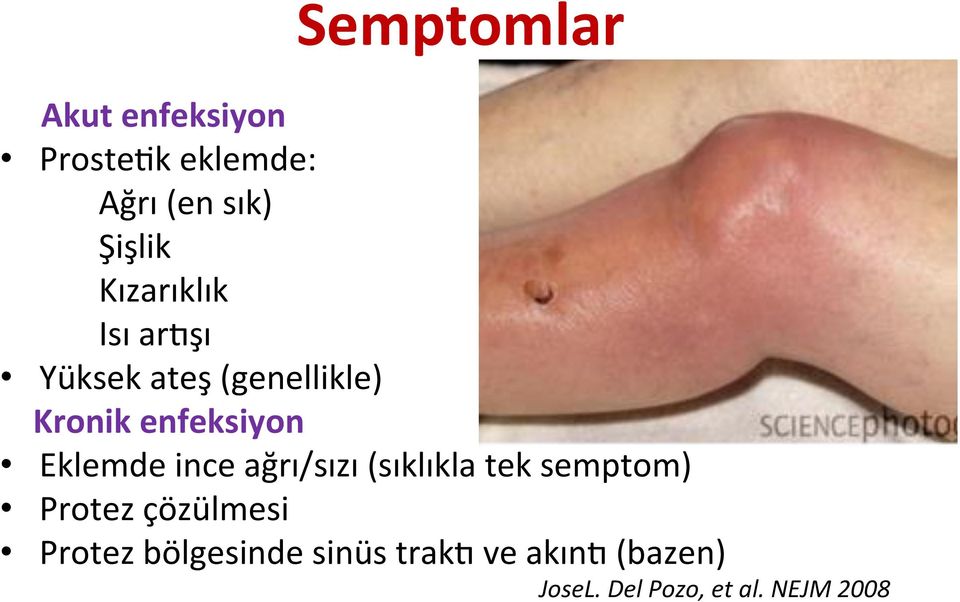 Eklemde ince ağrı/sızı (sıklıkla tek semptom) Protez çözülmesi