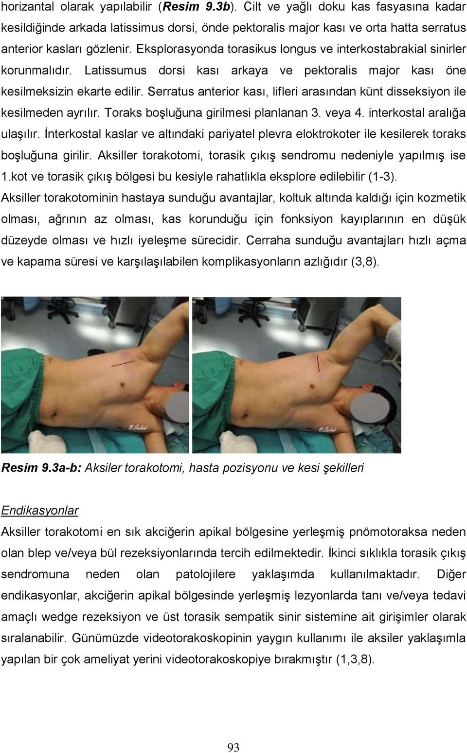 Serratus anterior kası, lifleri arasından künt disseksiyon ile kesilmeden ayrılır. Toraks boşluğuna girilmesi planlanan 3. veya 4. interkostal aralığa ulaşılır.