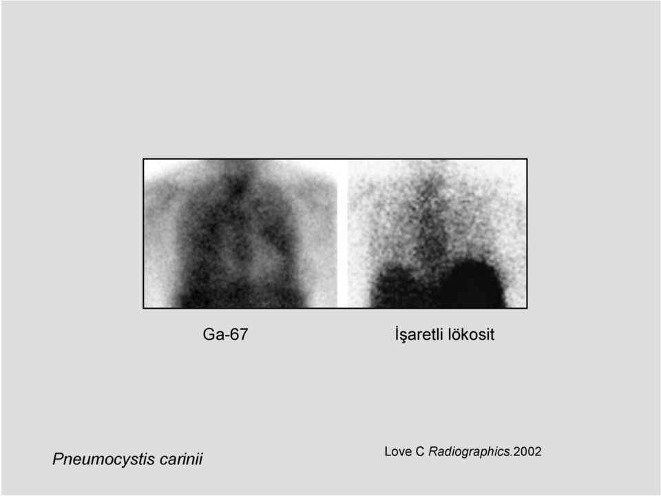 Pneumocystis