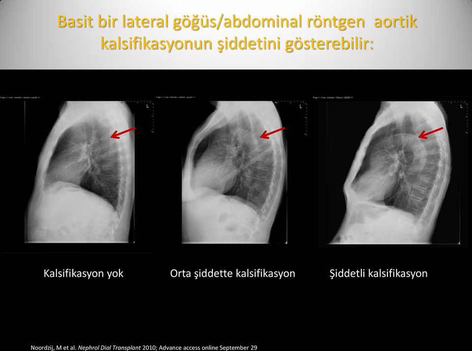 Orta şiddette kalsifikasyon Şiddetli kalsifikasyon Noordzij,