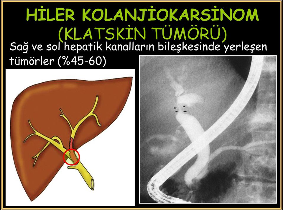 sol hepatik kanalların