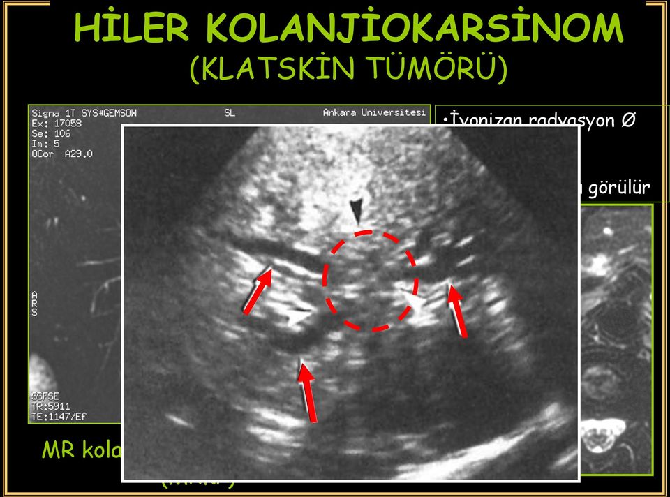 radyasyon Ø KM Ø Periduktal