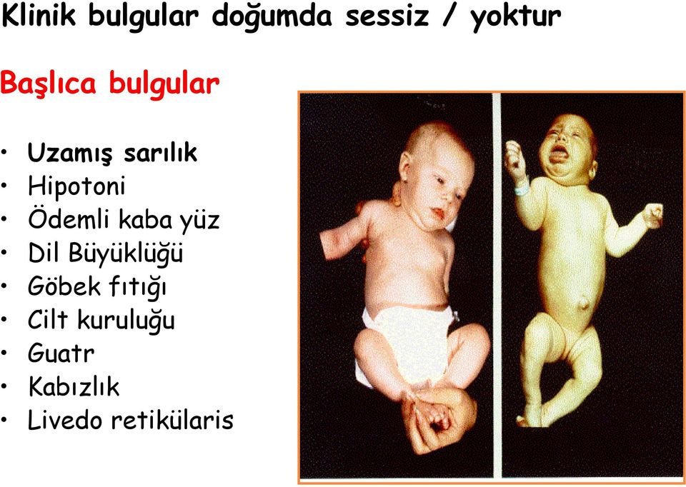 Ödemli kaba yüz Dil Büyüklüğü Göbek fıtığı