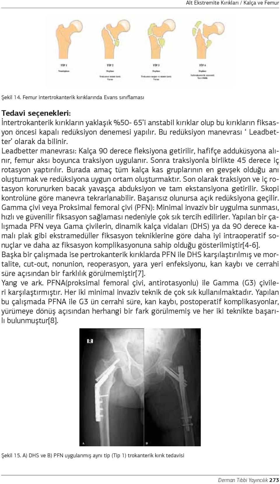 denemesi yapılır. Bu redüksiyon manevrası Leadbetter olarak da bilinir. Leadbetter manevrası: Kalça 90 derece fleksiyona getirilir, hafifçe adduküsyona alınır, femur aksı boyunca traksiyon uygulanır.