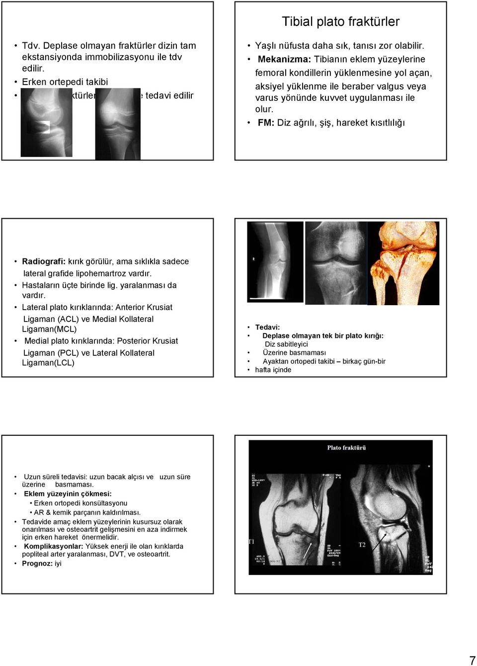 Mekanizma: Tibianın eklem yüzeylerine femoral kondillerin yüklenmesine yol açan, aksiyel yüklenme ile beraber valgus veya varus yönünde kuvvet uygulanması ile olur.