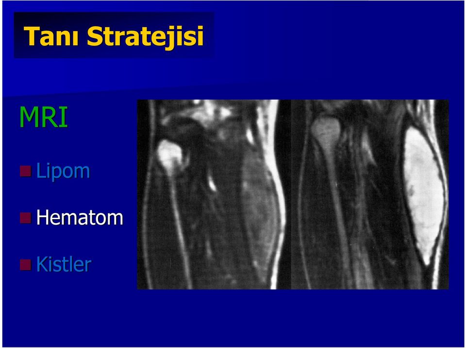 MRI Lipom