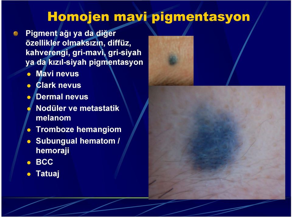 kızıl-siyah pigmentasyon Mavi nevus Clark nevus Dermal nevus