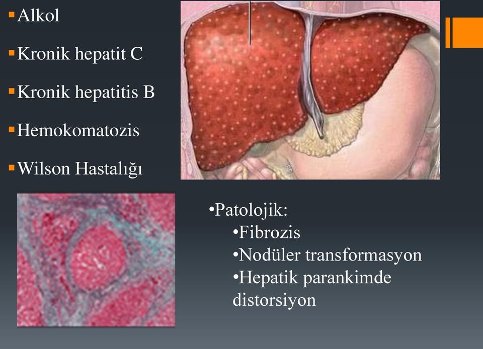Hastalığı Patolojik: Fibrozis
