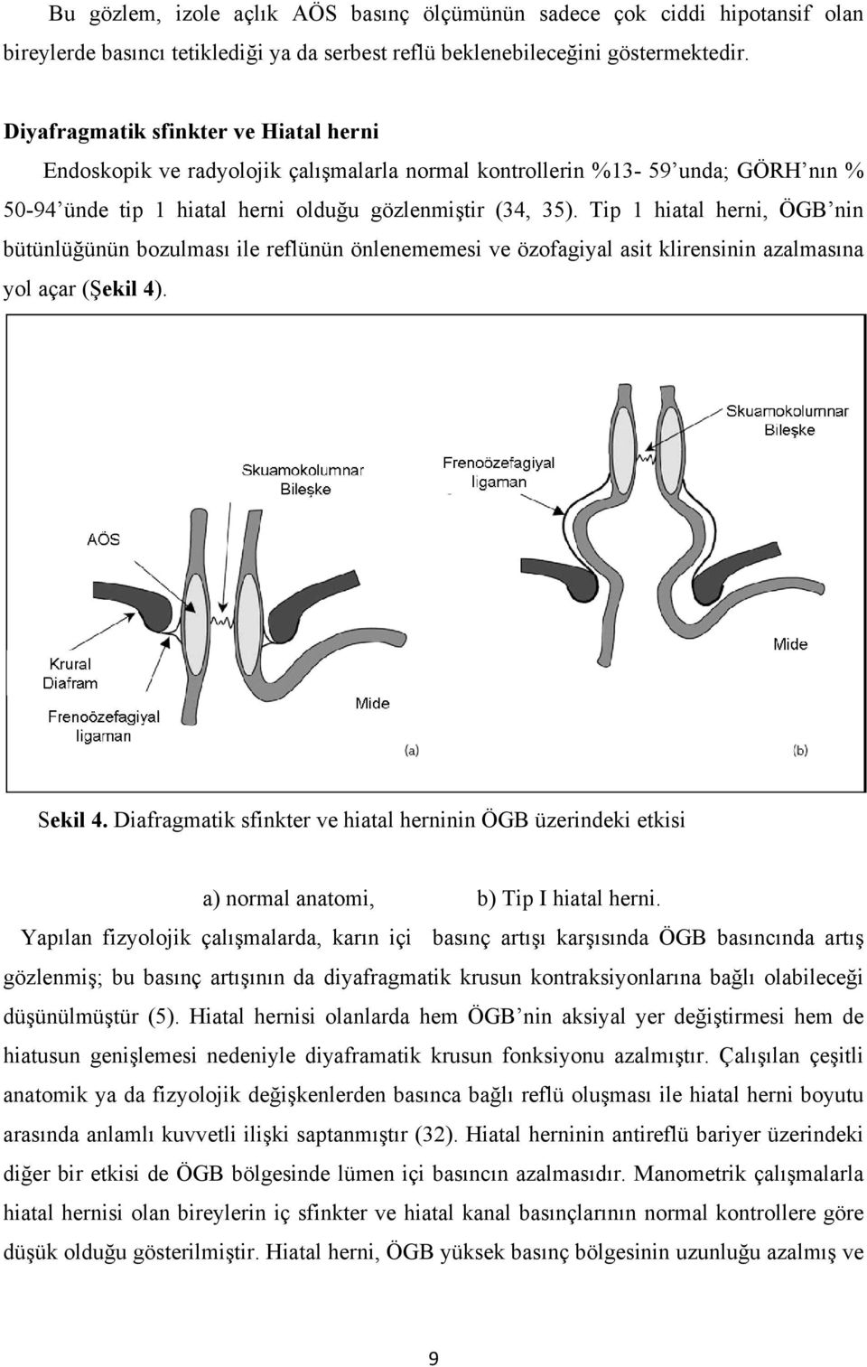 Tip 1 hiatal herni, ÖGB nin bütünlüğünün bozulması ile reflünün önlenememesi ve özofagiyal asit klirensinin azalmasına yol açar (Şekil 4). Sekil 4.