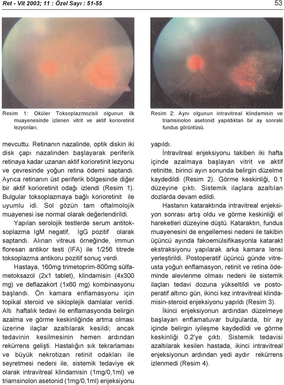Ayrıca retinanın üst periferik bölgesinde diğer bir aktif korioretinit odağı izlendi (Resim 1). Bulgular toksoplazmaya bağlı korioretinit ile uyumlu idi.
