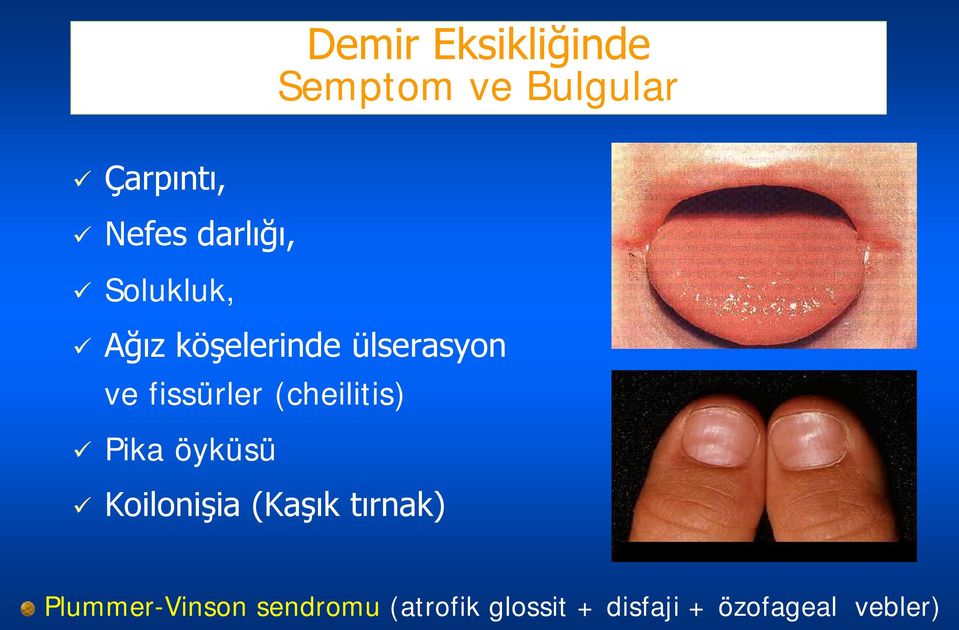 fissürler (cheilitis) Pika öyküsü Koilonişia (Kaşık