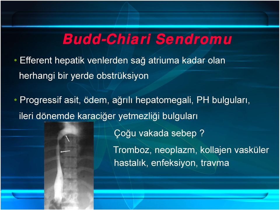 hepatomegali, PH bulguları, ileri dönemde karaciğer yetmezliği bulguları