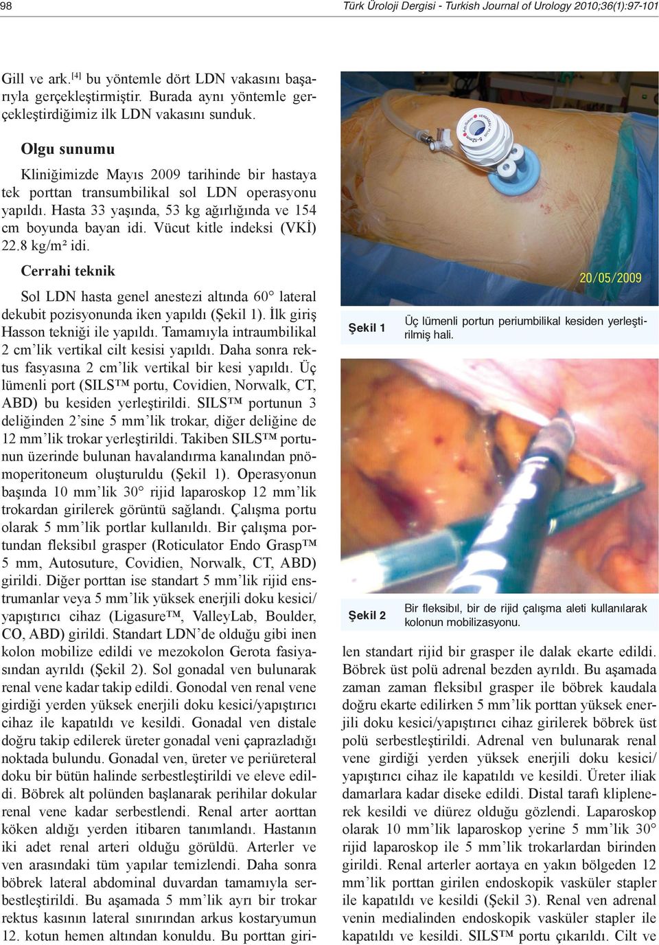 Bir fleksibıl, bir de rijid çalışma aleti kullanılarak kolonun mobilizasyonu. Kliniğimizde Mayıs 2009 tarihinde bir hastaya tek porttan transumbilikal sol LDN operasyonu yapıldı.