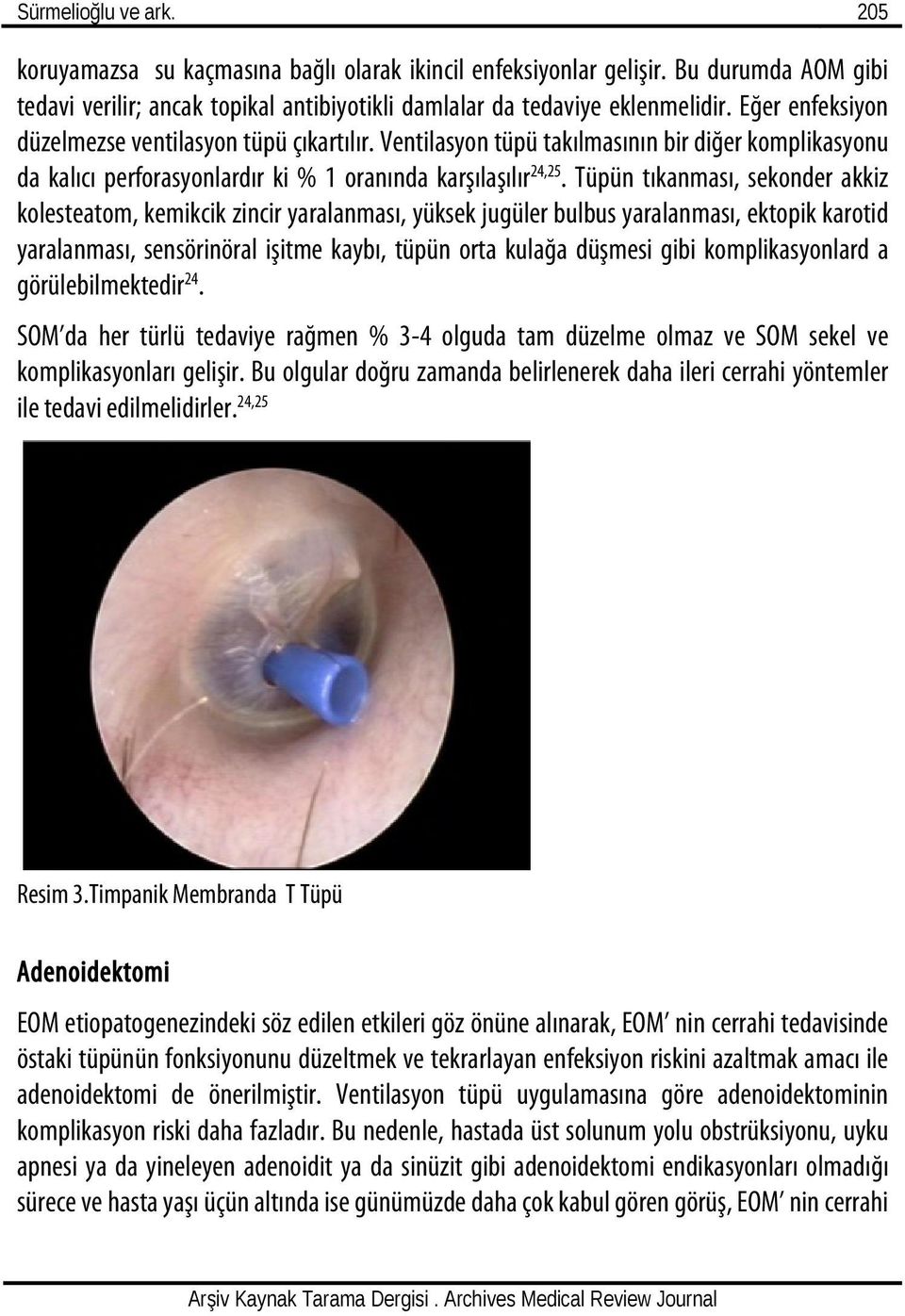 Tüpün tıkanması, sekonder akkiz kolesteatom, kemikcik zincir yaralanması, yüksek jugüler bulbus yaralanması, ektopik karotid yaralanması, sensörinöral işitme kaybı, tüpün orta kulağa düşmesi gibi