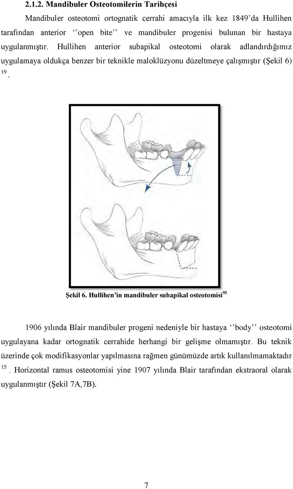 Hullihen in mandibuler subapikal osteotomisi 95 1906 yılında Blair mandibuler progeni nedeniyle bir hastaya body osteotomi uygulayana kadar ortognatik cerrahide herhangi bir geliģme