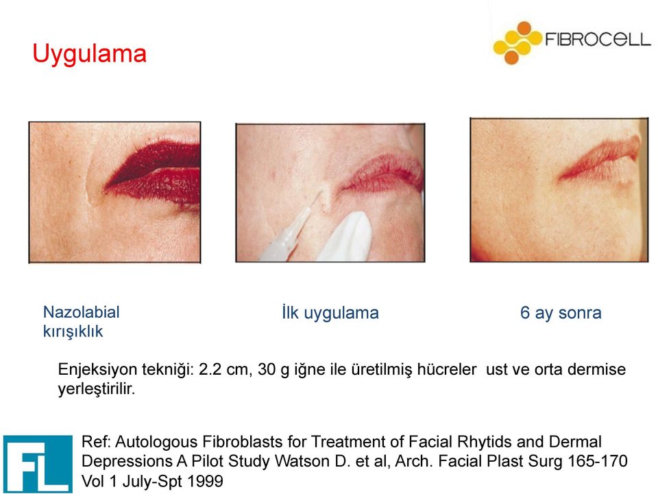 Ref: Autologous Fibroblasts for Treatment of Facial Rhytids and Dermal