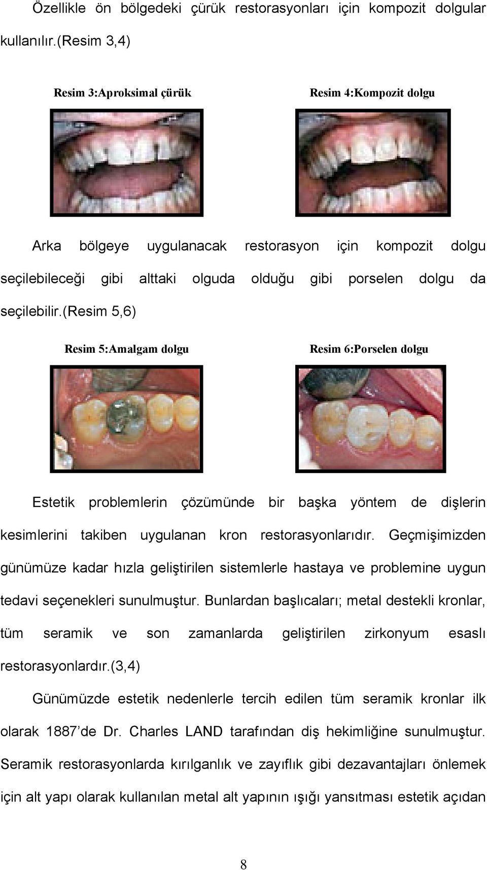 (resim 5,6) Resim 5:Amalgam dolgu Resim 6:Porselen dolgu Estetik problemlerin çözümünde bir başka yöntem de dişlerin kesimlerini takiben uygulanan kron restorasyonlarıdır.