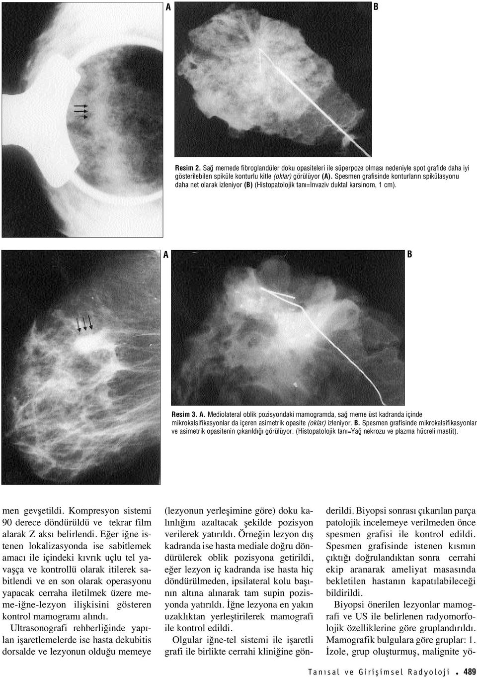 Resim 3. A. Mediolateral oblik pozisyondaki mamogramda, sa meme üst kadranda içinde mikrokalsifikasyonlar da içeren asimetrik opasite (oklar) izleniyor.