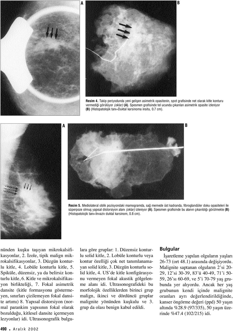 Mediolateral oblik pozisyondaki mamogramda, sa memede üst kadranda, fibroglandüler doku opasiteleri ile süperpoze olmufl yap sal distorsiyon alan (oklar) izleniyor (A).