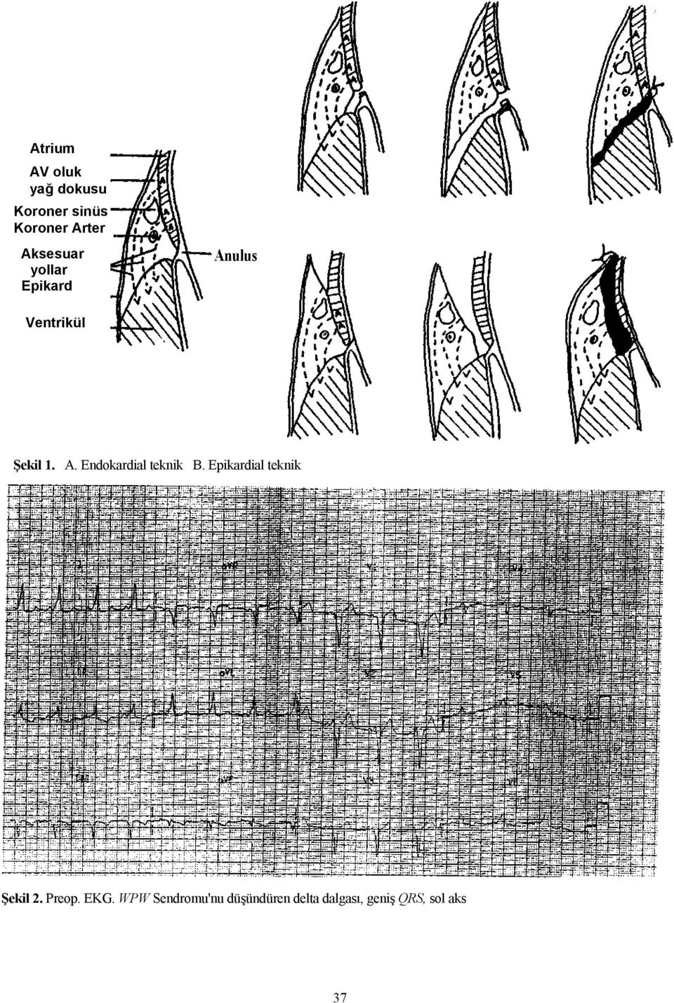 Epikardial teknik Şekil 2. Preop. EKG.