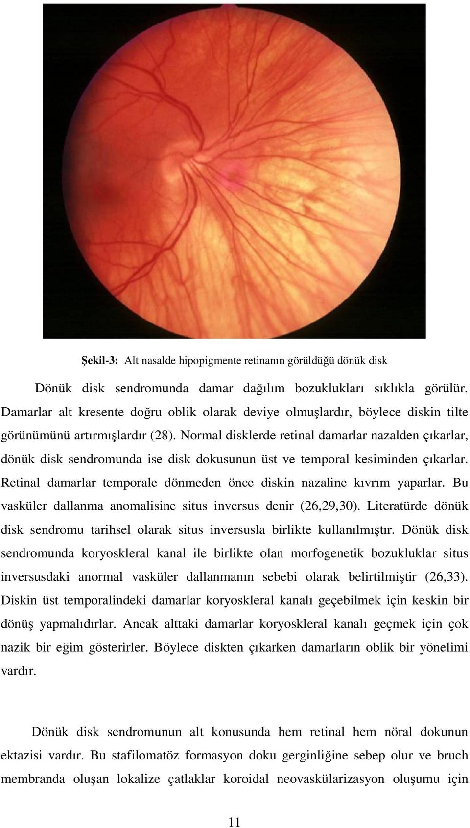 Normal disklerde retinal damarlar nazalden çıkarlar, dönük disk sendromunda ise disk dokusunun üst ve temporal kesiminden çıkarlar.