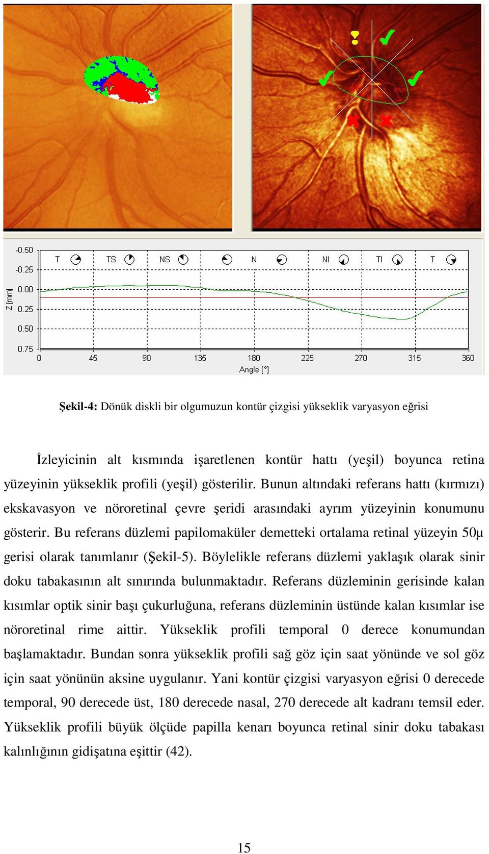 Bu referans düzlemi papilomaküler demetteki ortalama retinal yüzeyin 50µ gerisi olarak tanımlanır (Şekil-5).