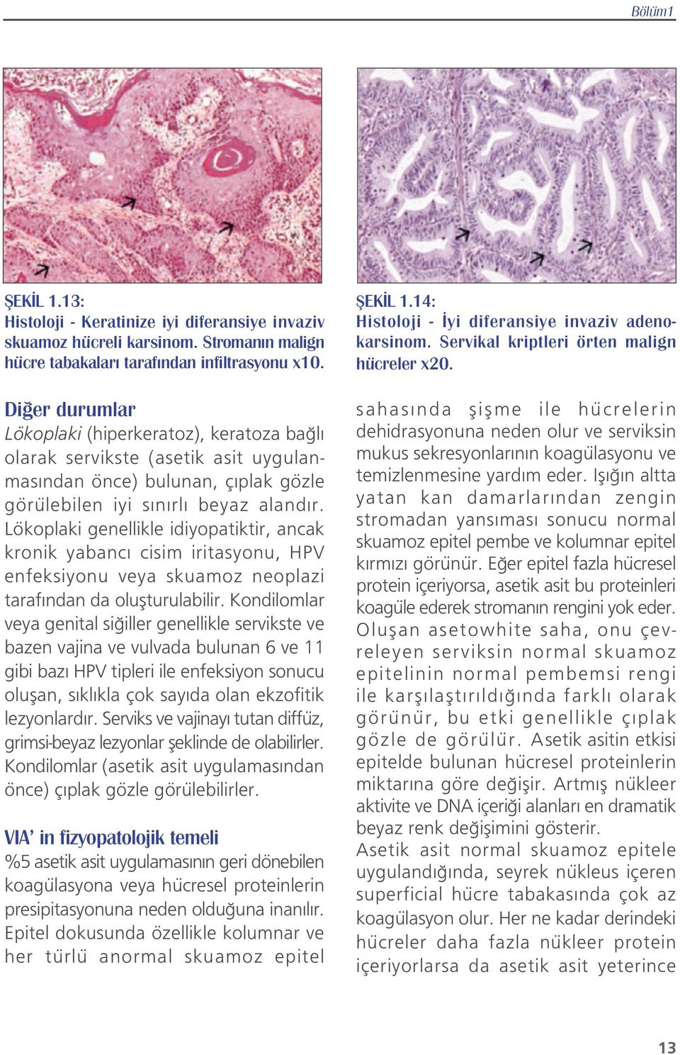 Lökoplaki genellikle idiyopatiktir, ancak kronik yabanc cisim iritasyonu, HPV enfeksiyonu veya skuamoz neoplazi taraf ndan da oluflturulabilir.