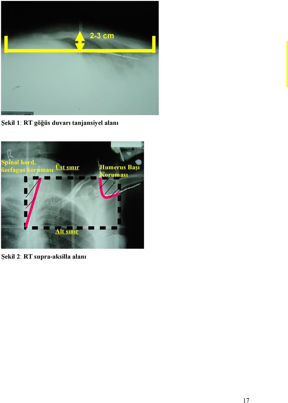 koruması Üst sınır Humerus Başı