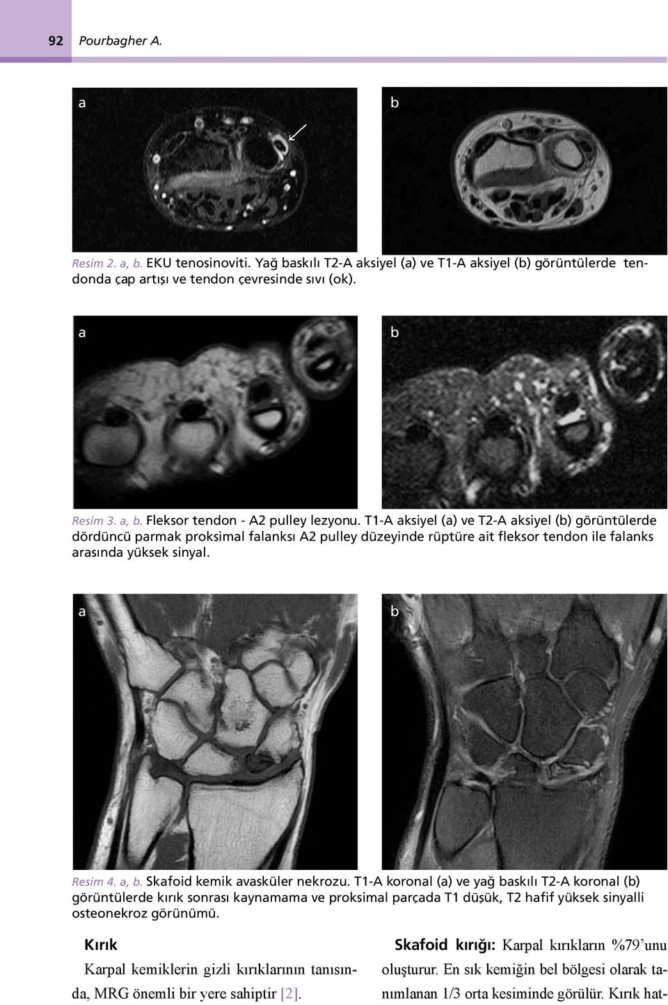 Skfoid kemik vsküler nekrozu. T1-A koronl () ve yğ skılı T2-A koronl () görüntülerde kırık sonrsı kynmm ve proksiml prçd T1 düşük, T2 hfif yüksek sinylli osteonekroz görünümü.
