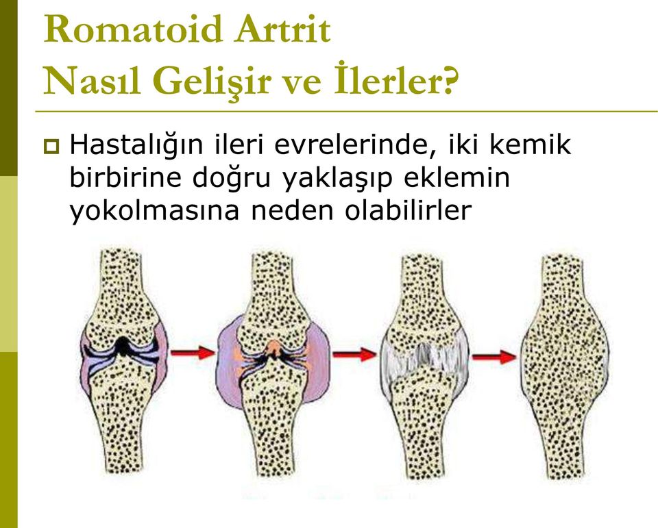 Hastalığın ileri evrelerinde, iki