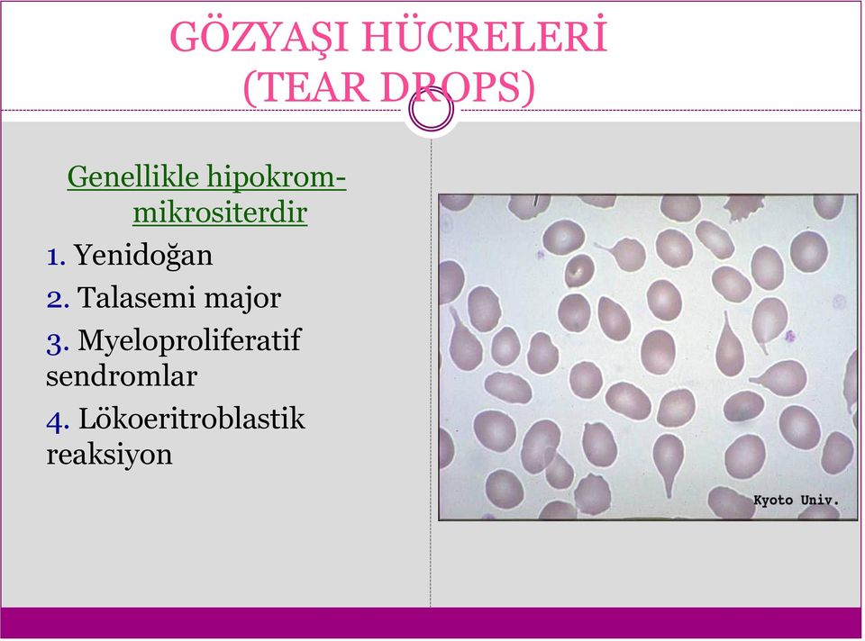 Yenidoğan 2. Talasemi major 3.