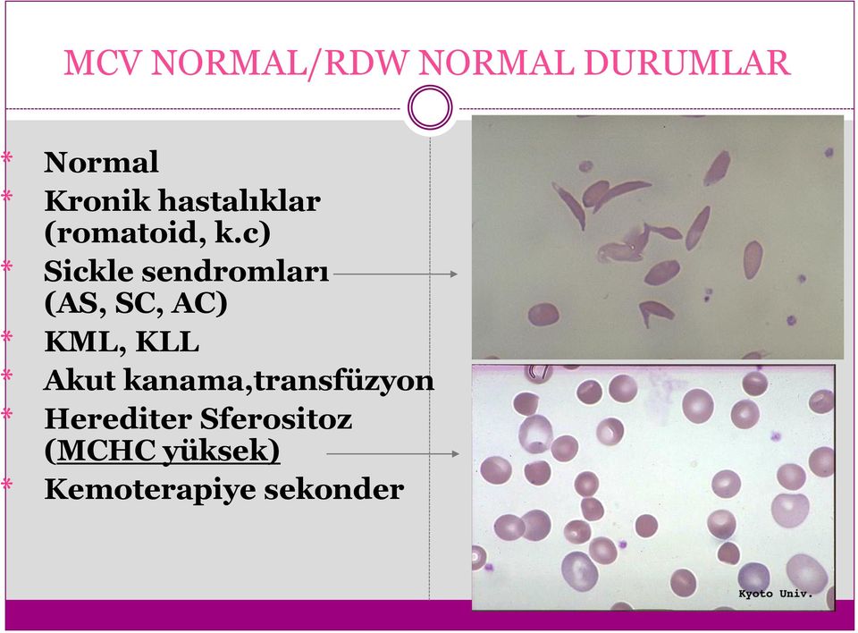 c) * Sickle sendromları (AS, SC, AC) * KML, KLL *