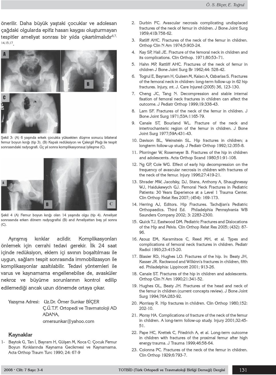 Üç yıl sonra komplikasyonsuz iyileşme (C). Şekil 4 (A) Femur boyun kırığı olan 14 yaşında olgu (tip 4). Ameliyat sonrasında erken dönem radyografisi (B) and Ameliyattan beş yıl sonra (C).