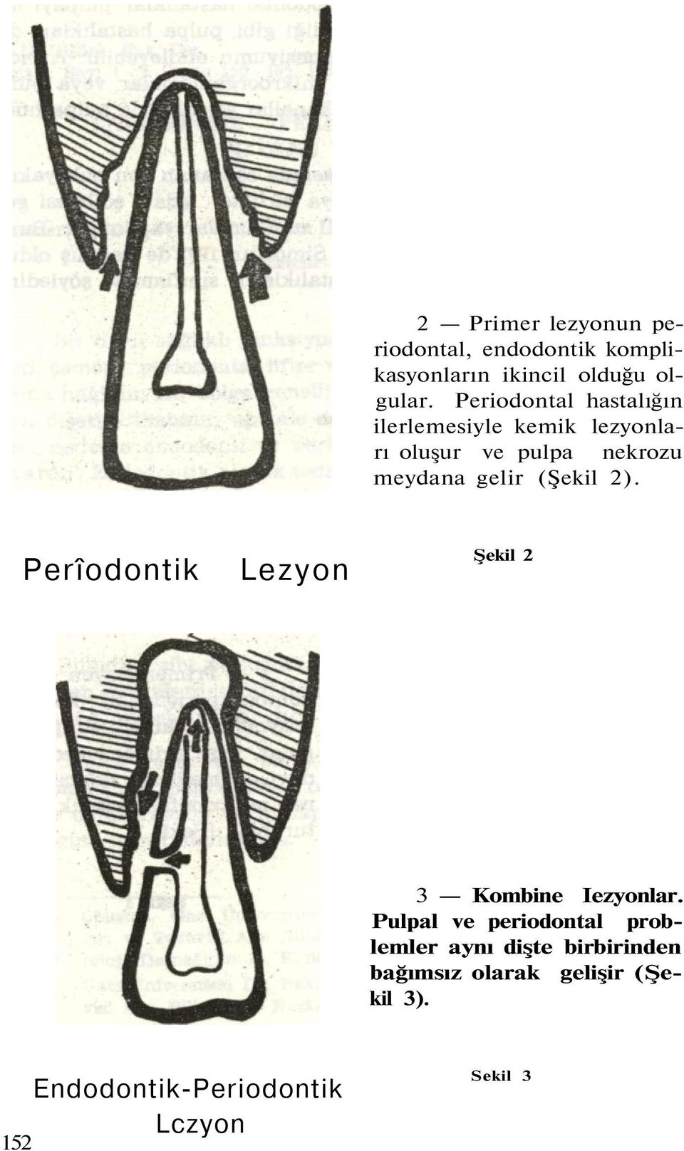 (Şekil 2). Perîodontik Lezyon Şekil 2 3 Kombine Iezyonlar.