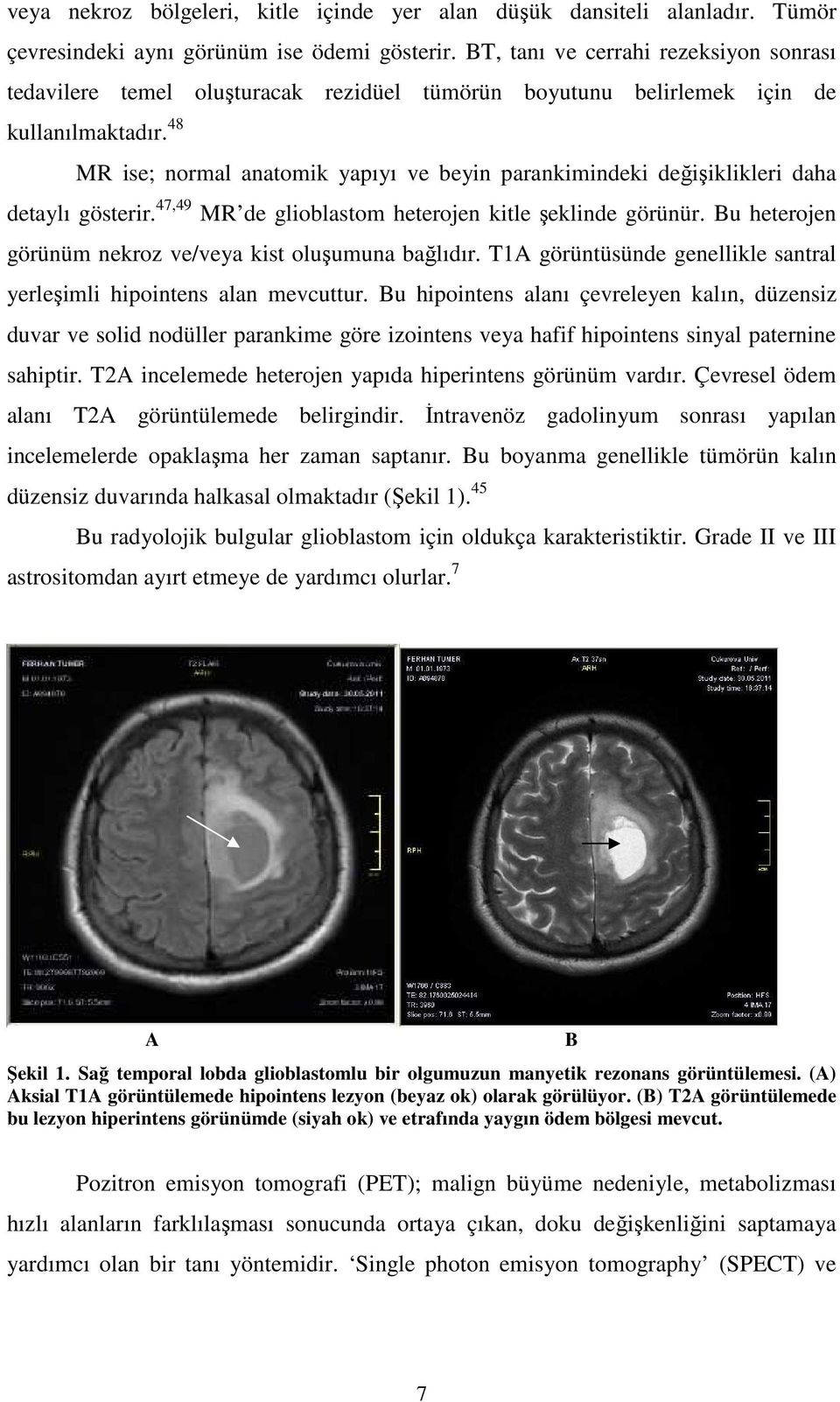 48 MR ise; normal anatomik yapıyı ve beyin parankimindeki değişiklikleri daha detaylı gösterir. 47,49 MR de glioblastom heterojen kitle şeklinde görünür.