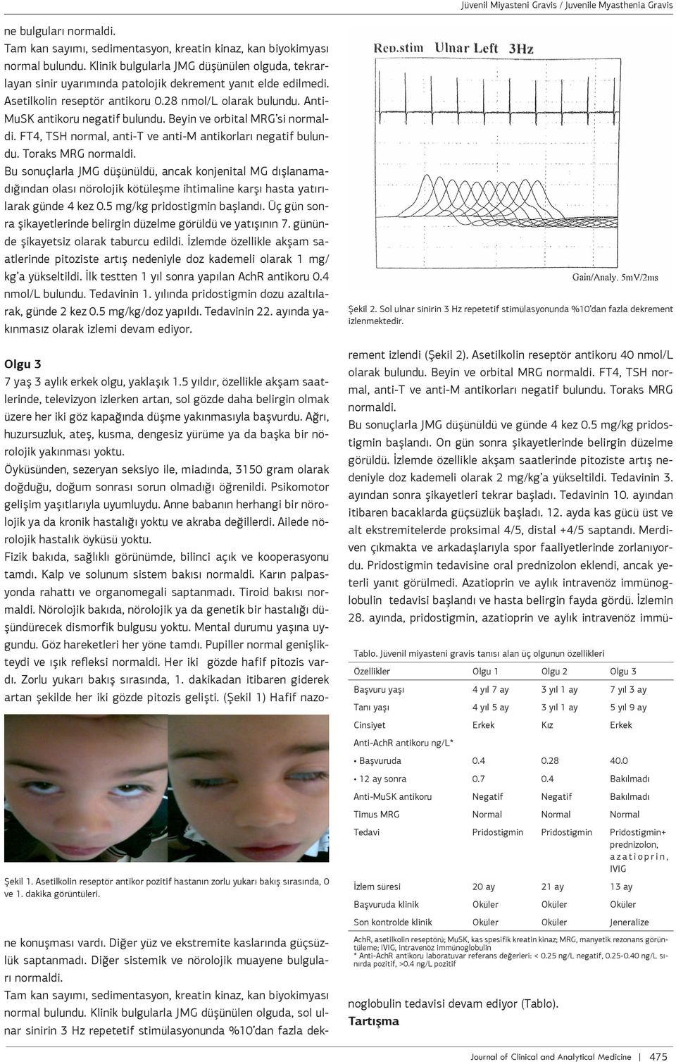 Bu sonuçlrl JMG düşünüldü, nck konjenitl MG dışlnmdığındn olsı nörolojik kötüleşme ihtimline krşı hst ytırılrk günde 4 kez 0.5 mg/kg pridostigmin bşlndı.