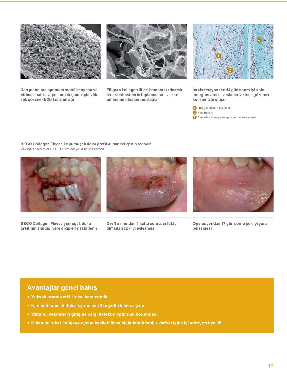 enfeksiyonsuz BEGO Collagen Fleece ile yumuşak doku grefti alınan bölgenin tedavisi Vakaya ait resimler Dr. H.
