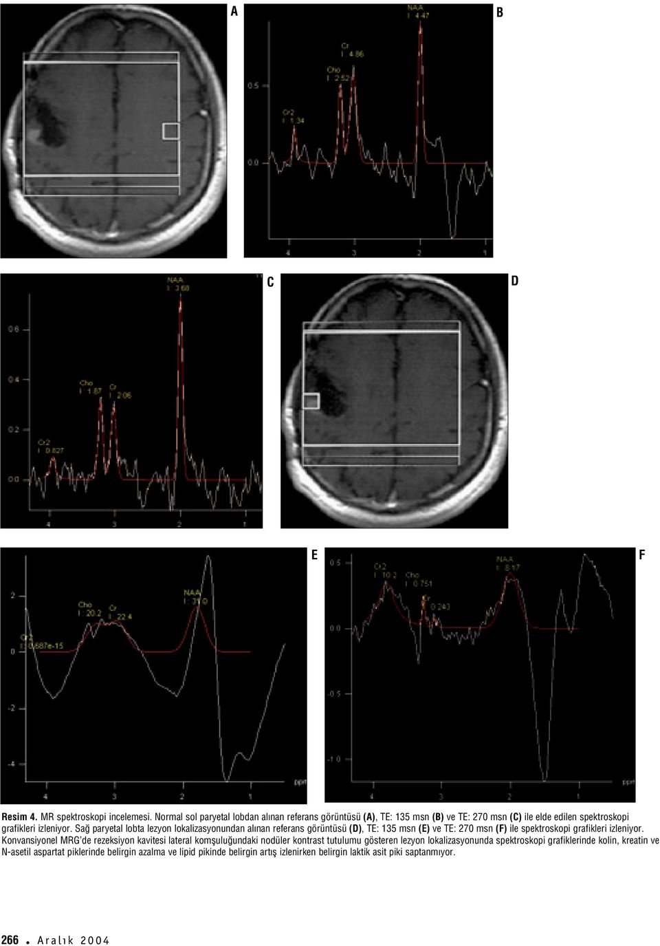 Sa paryetal lobta lezyon lokalizasyonundan al nan referans görüntüsü (D), TE: 135 msn (E) ve TE: 270 msn (F) ile spektroskopi grafikleri izleniyor.