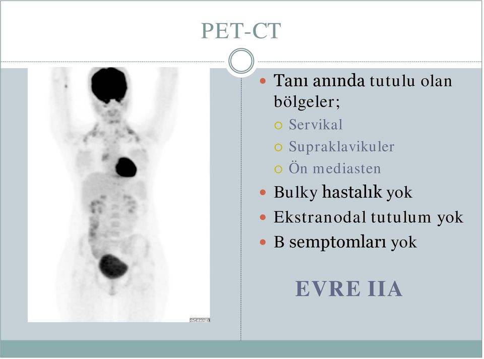 Ön mediasten Bulky hastalık yok