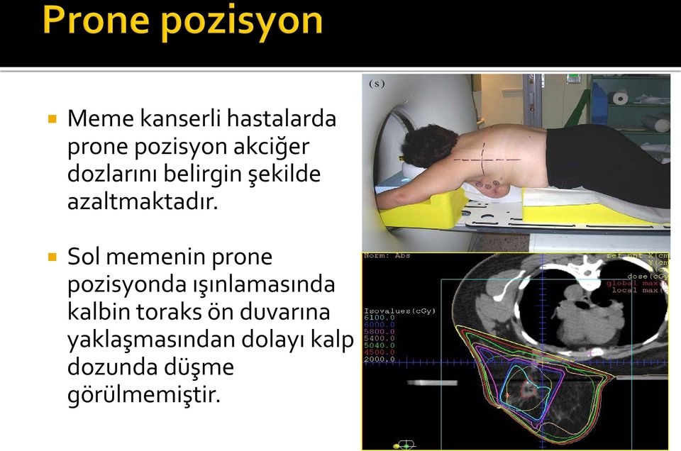 Sol memenin prone pozisyonda ışınlamasında kalbin