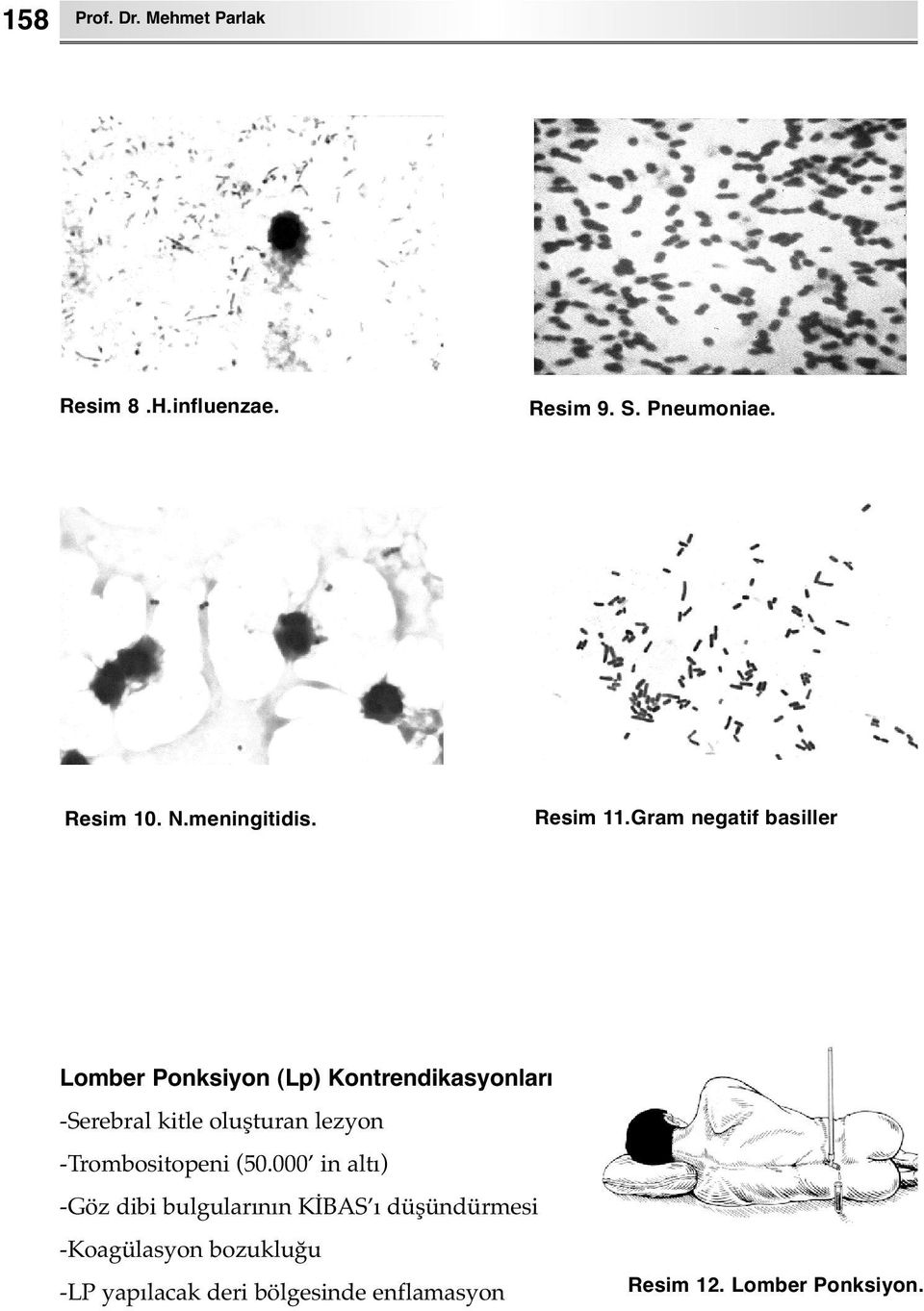 Gram negatif basiller Lomber Ponksiyon (Lp) Kontrendikasyonları -Serebral kitle oluşturan