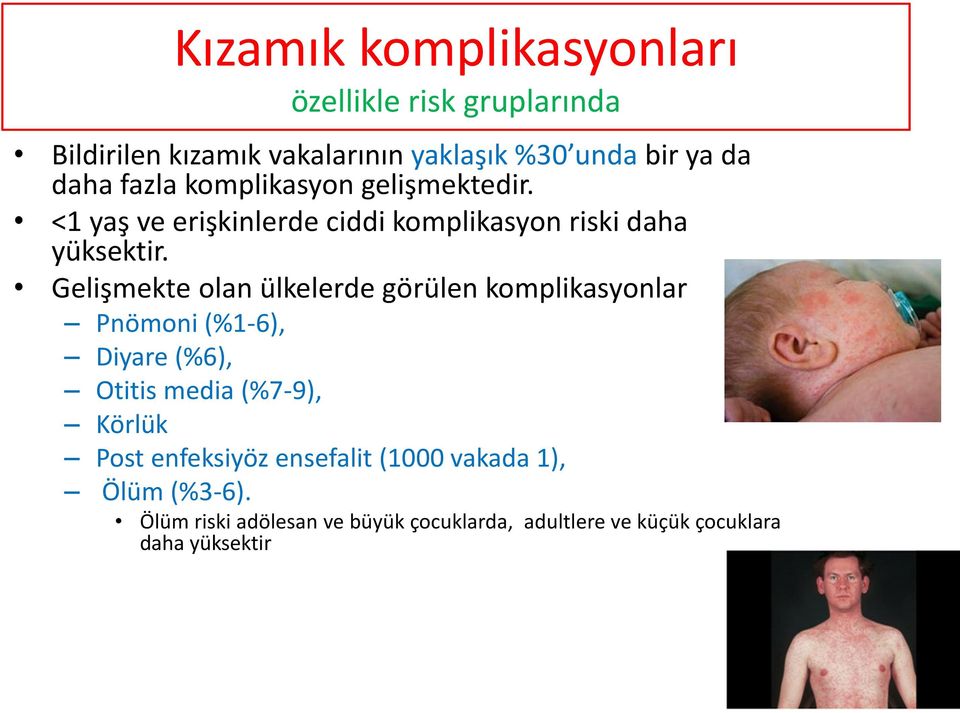 Gelişmekte olan ülkelerde görülen komplikasyonlar Pnömoni (%1-6), Diyare (%6), Otitis media (%7-9), Körlük Post