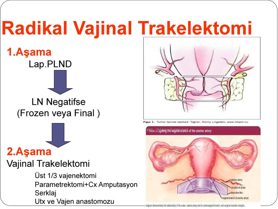 Aşama Vajinal Trakelektomi Üst 1/3 vajenektomi