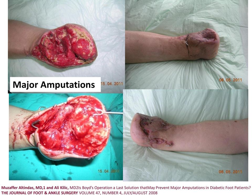 Major Amputations in Diabetic Foot Patients?