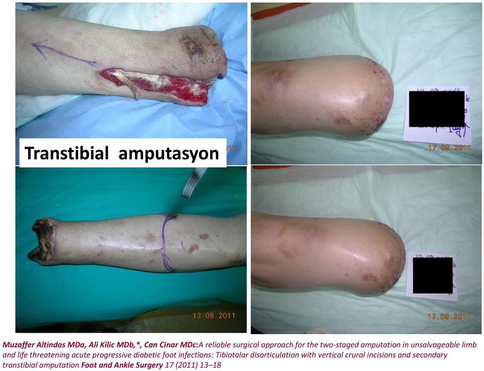 threatening acute progressive diabetic foot infections: Tibiotalar disarticulation with