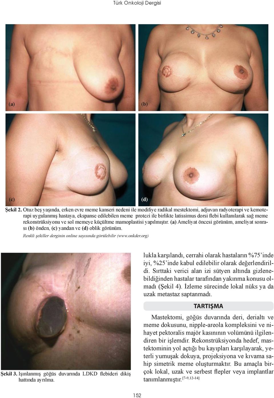 flebi kullanılarak sağ meme rekonstrüksiyonu ve sol memeye küçültme mamoplastisi yapılmıştır. (a) Ameliyat öncesi görünüm, ameliyat sonrası (b) önden, (c) yandan ve (d) oblik görünüm.