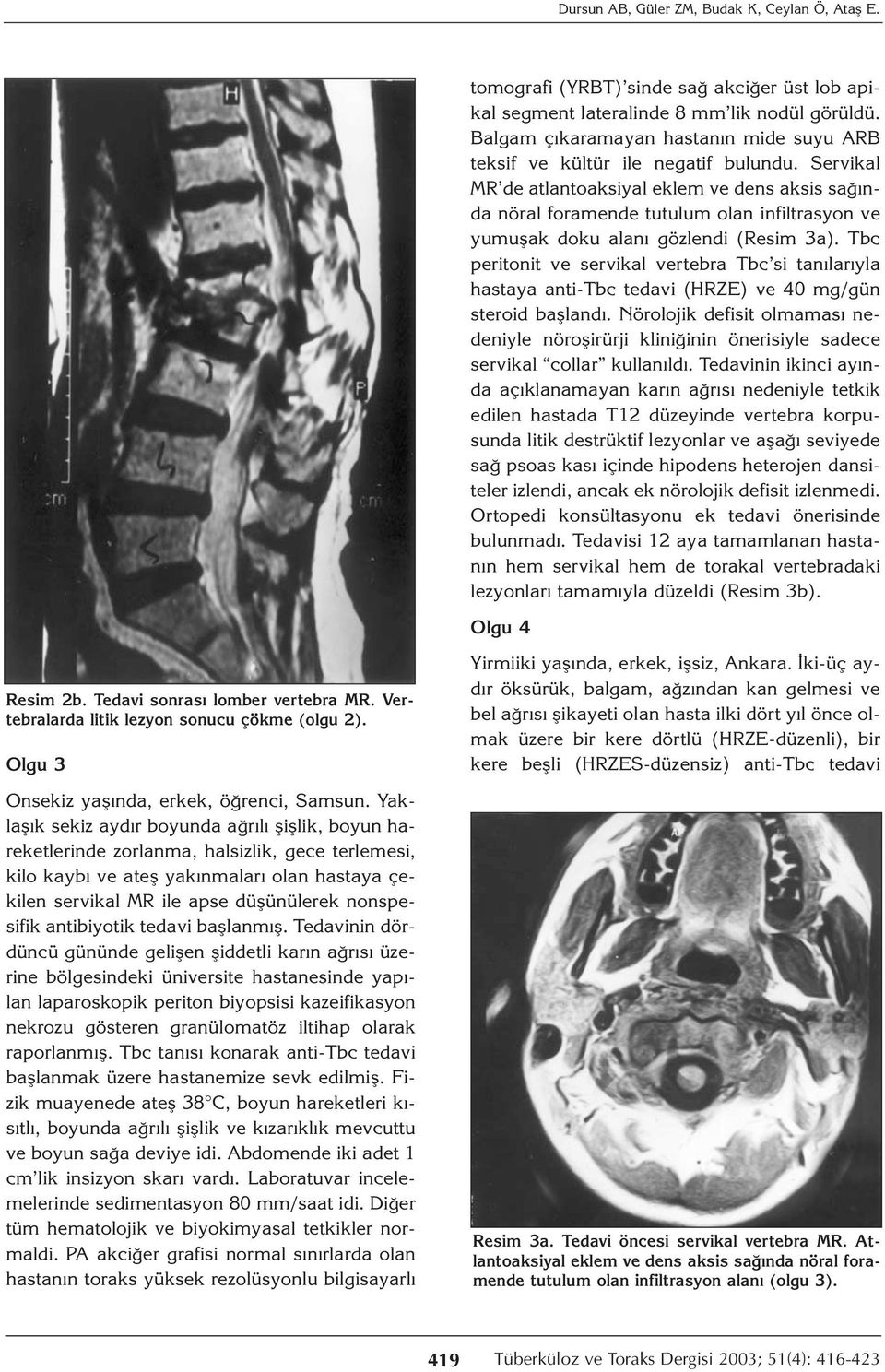 Servikal MR de atlantoaksiyal eklem ve dens aksis sağında nöral foramende tutulum olan infiltrasyon ve yumuşak doku alanı gözlendi (Resim 3a).