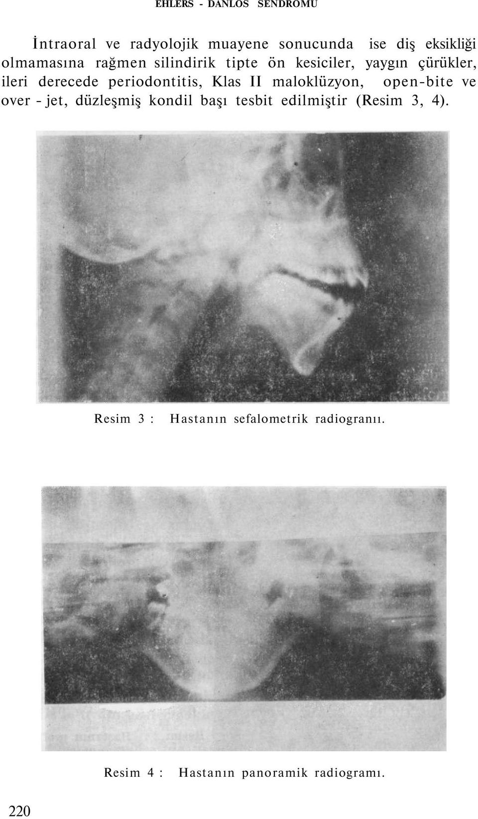 periodontitis, Klas II maloklüzyon, open-bite ve over - jet, düzleşmiş kondil başı tesbit