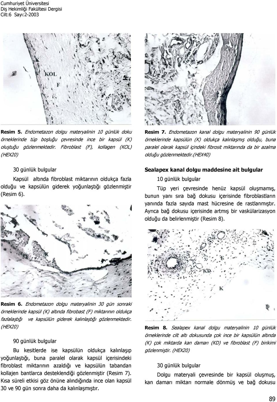 (hex40) Kapsül altında fibroblast miktarının oldukça fazla olduğu ve kapsülün giderek yoğunlaştığı gözlenmiştir (Resim 6).